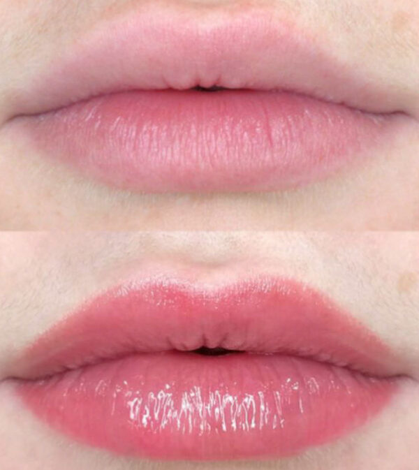 Microlips